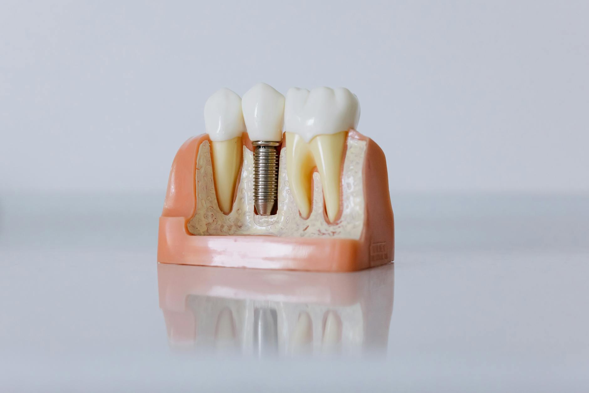 Detailed dental implant model showing artificial teeth and jaw structure